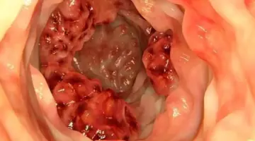 العلاج المناعي الكيميائي يُقلص انتكاس سرطان القولون